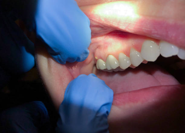 Best Emergency Tooth Extraction in Huntington Woods, MI